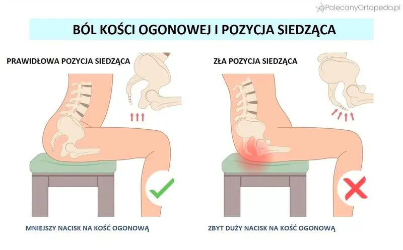 Ból kości ogonowej w ciąży – przyczyny i bezpieczne sposoby ulgi