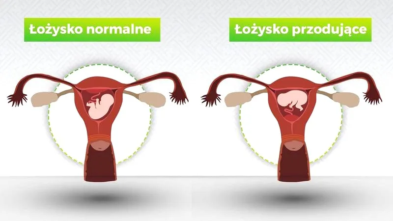 Łożysko przodujące – objawy, ryzyko i bezpieczna ciąża