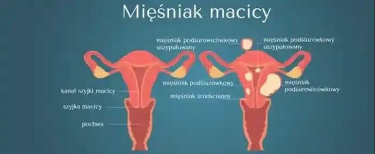 Mięśniaki zniknęły? Co może oznaczać ich samoistna regresja