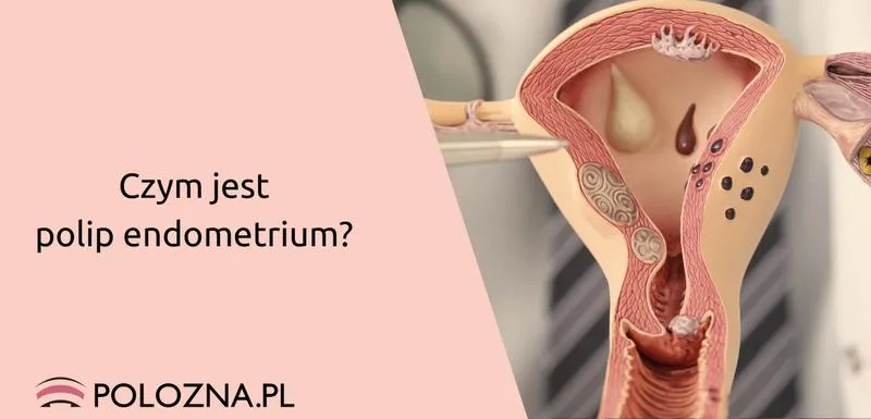 Diagnostyka polipów endometrialnych