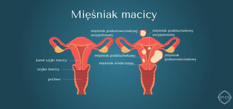 Mięśniaki macicy