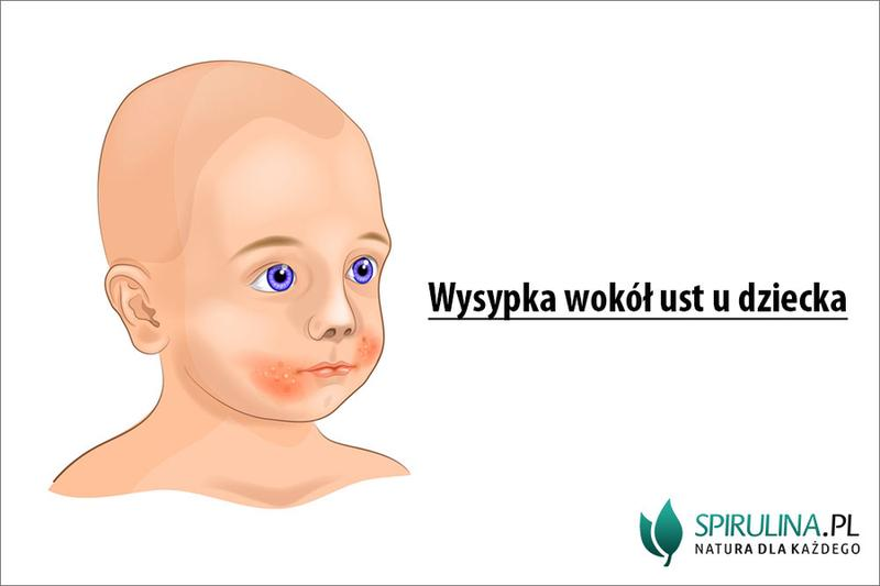 Nieswędząca wysypka u dziecka