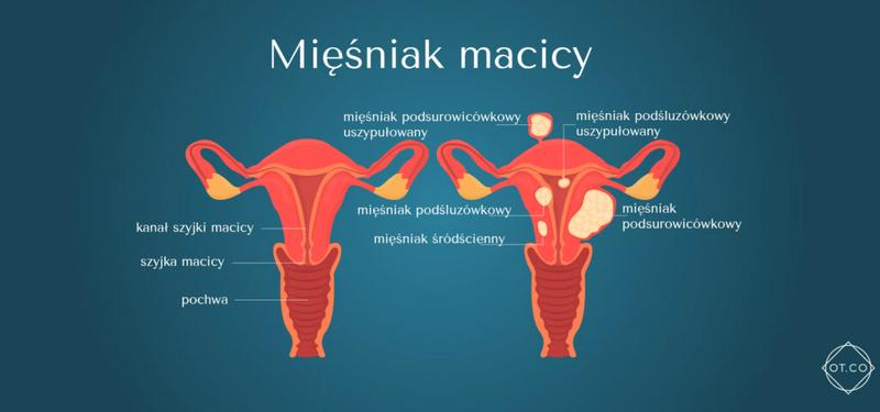 Objawy mięśniaków macicy