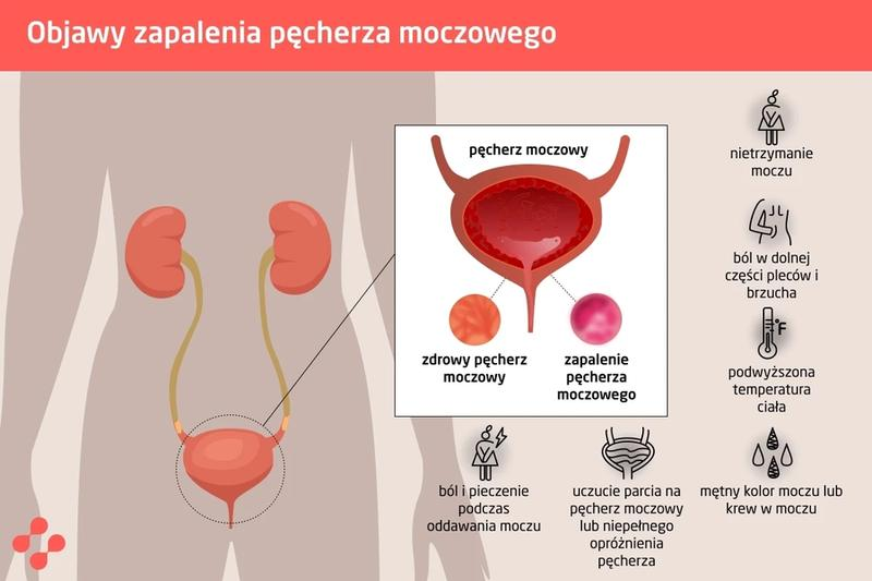 Objawy zapalenia pęcherza