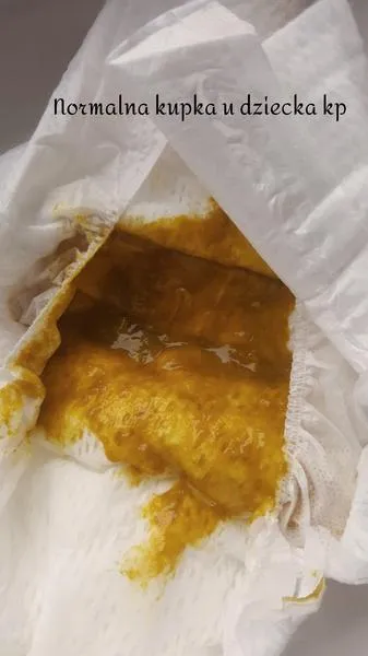 Pienista kupka u niemowlaka